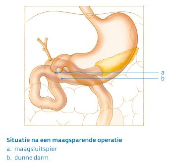 Alvleesklier na maagsparende operatie