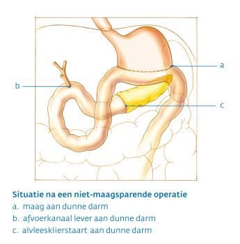 Alvleesklier na niet maagsparende operatie