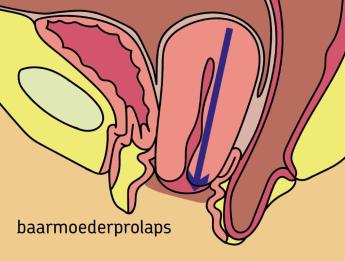 baarmoederverzakking