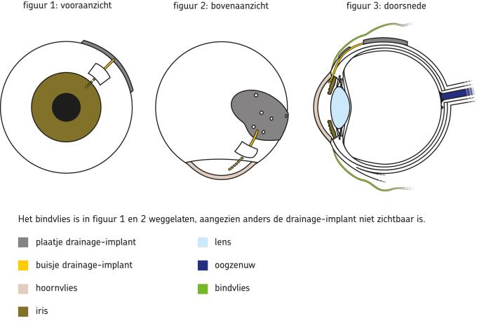 vooraanzicht-bovenaanzicht en doorsnede van het oog waar implant zit