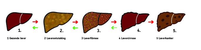 Leververvetting